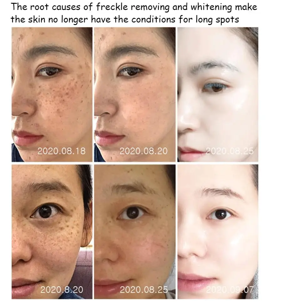 377 whitening cream VC cream freckles chloasma senile plaques beauty salons yellowing cream control cream