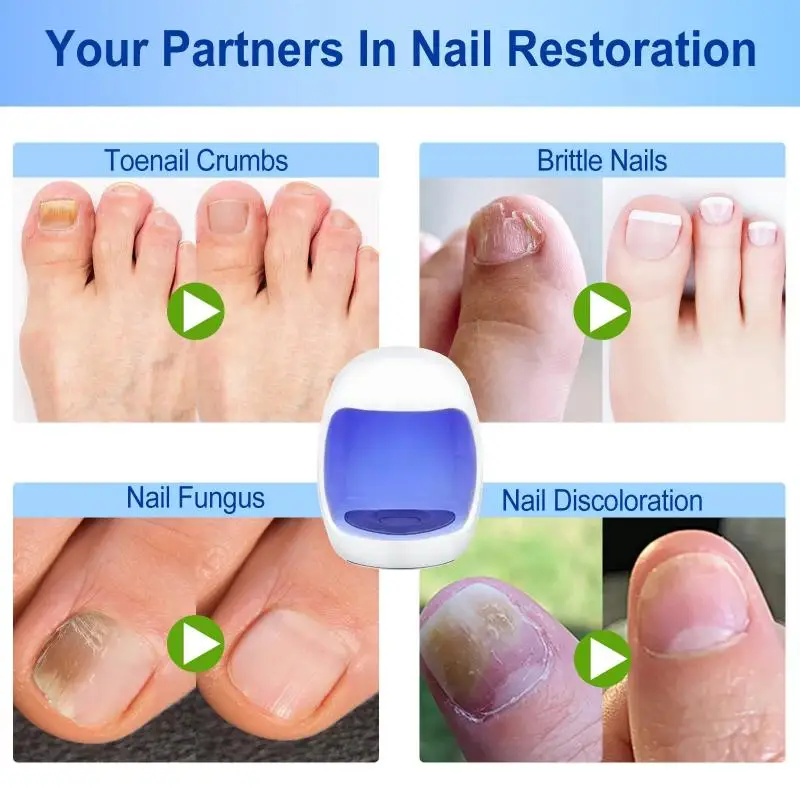 Fungal Nail Device Repair Fast Nails Fungus Onychomycosis