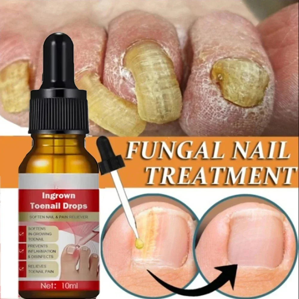 

Extra Strong Nail Fungus Treatment Serum Essence oil Feet Nails Repair Care Essence Cream Anti Infection Toe Fungal Removal