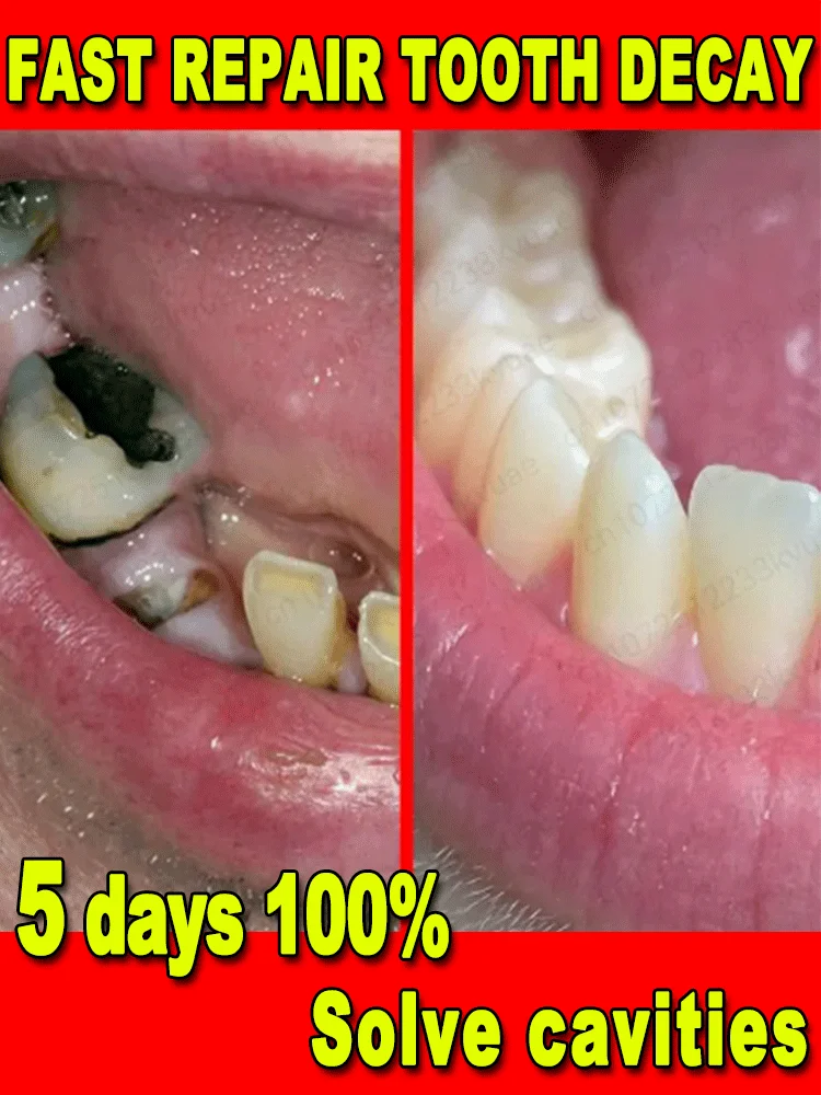 Repair cavities, Prevent tooth decay,remove plaque, toothache, whiten teeth, relieve periodontitis, freshen up bad breath