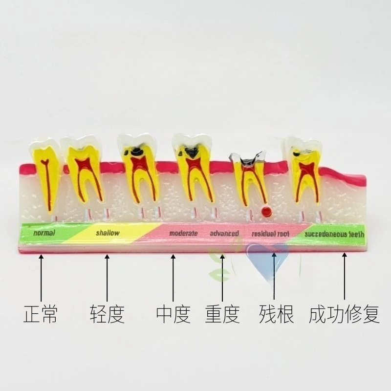 Lab Caries Classification Model 2 Times Tooth Model, Tooth Decay Bad Teeth Show Secondary Caries Shallow Deep Caries Mold s