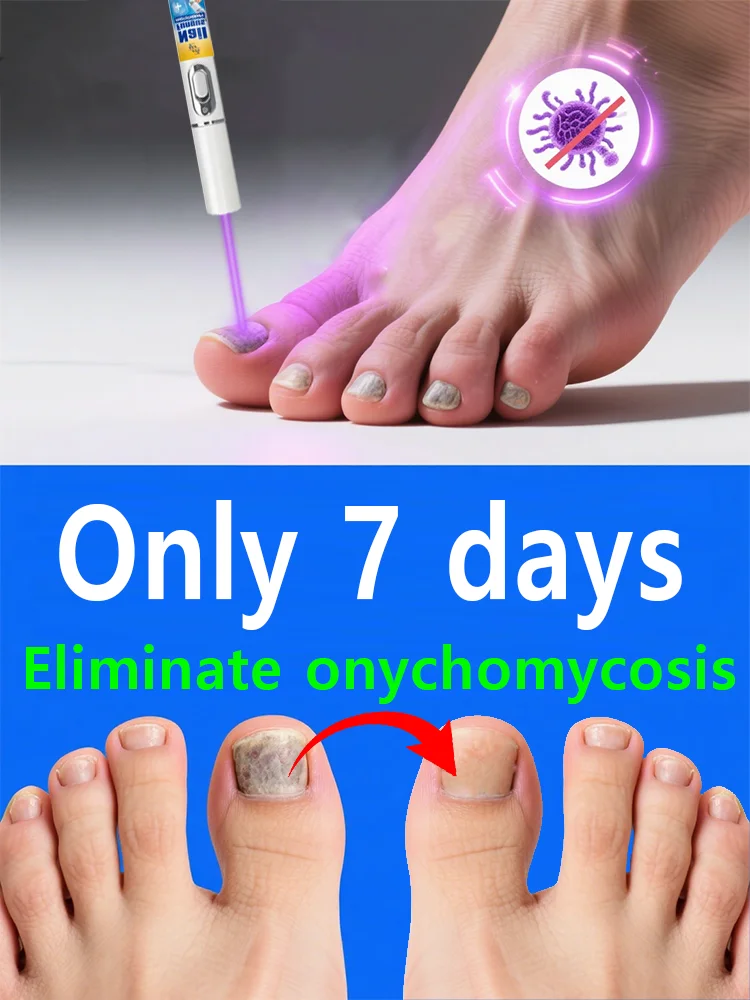 

Одобренный лазер для лечения грибка ногтей — быстрое результаты на 7 дней, безболезненное и безопасное устройство для домашнего использования