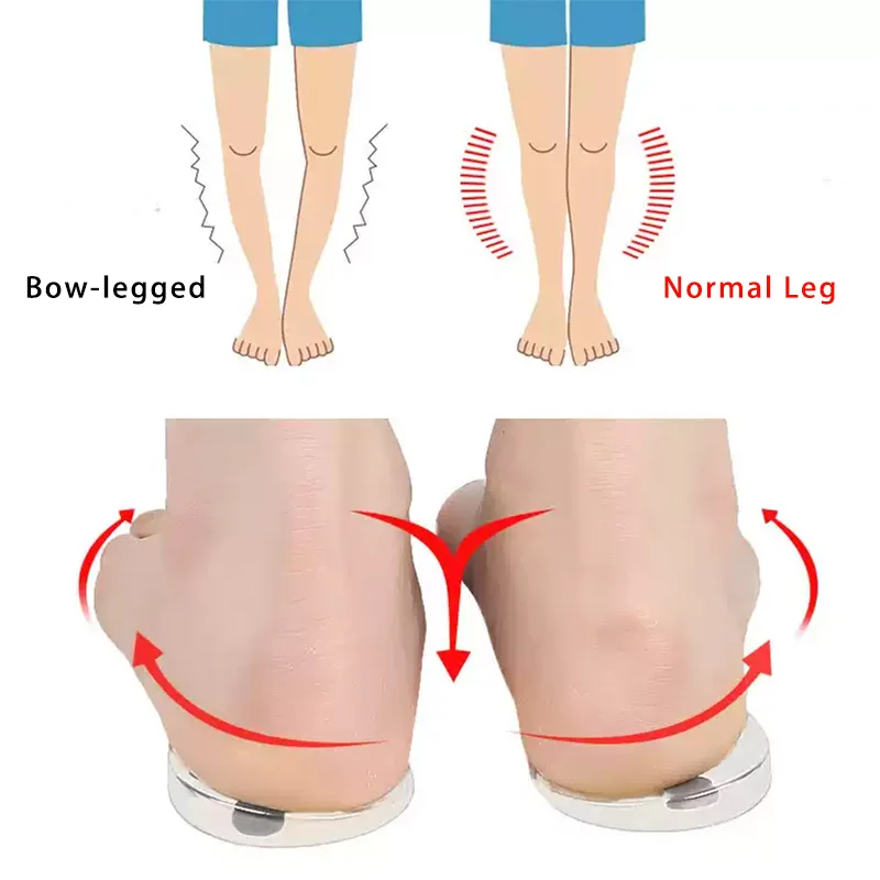 

1Pair Magnet Silicone O/X Type Orthopedic Massage Insoles Gel Heel Pads Corrector Valgus Varus Foot Shoe Insole Insert Feet Care