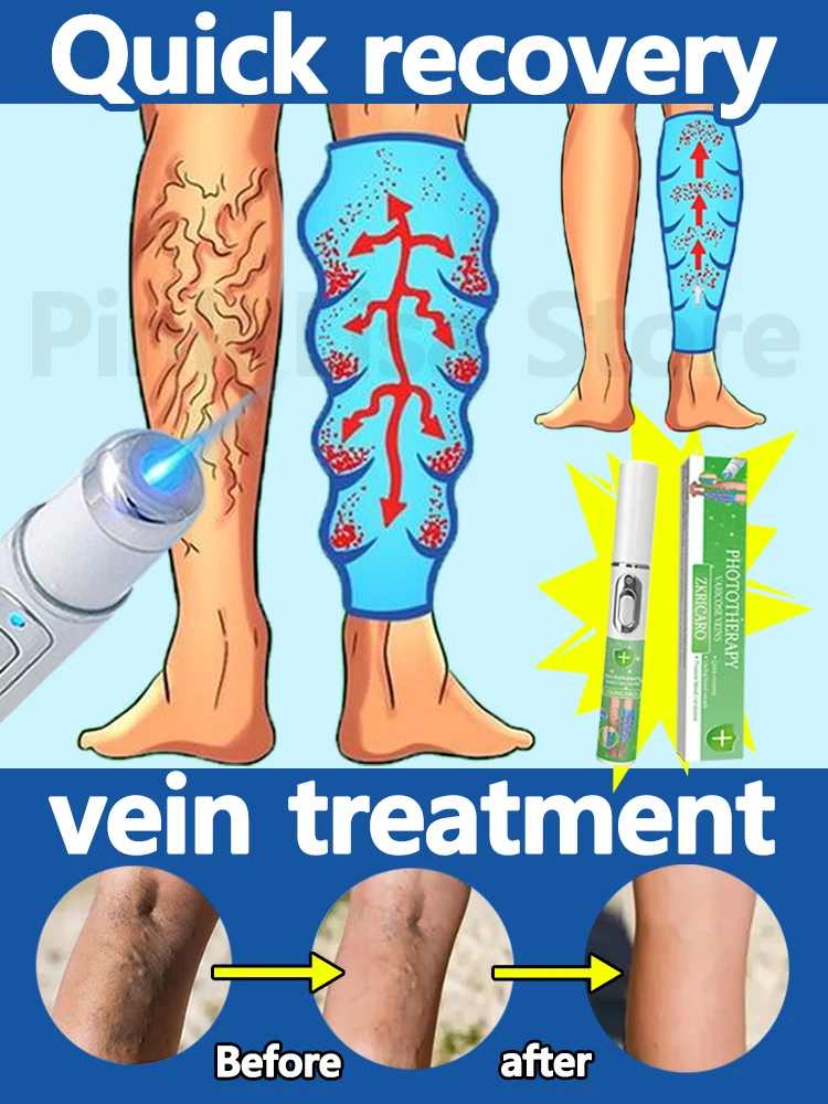 

Nanolaser fix Vein problems