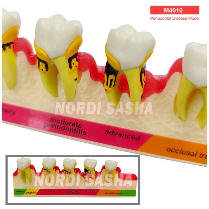 1Pcs M4010 Periodontal Disease Model Dental Typodont Periodontal Disease Progression Teaching Model Demonstration Model