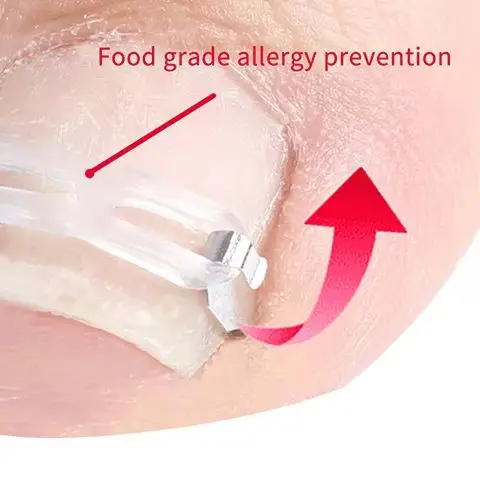 1Set Ingrown Toenai…