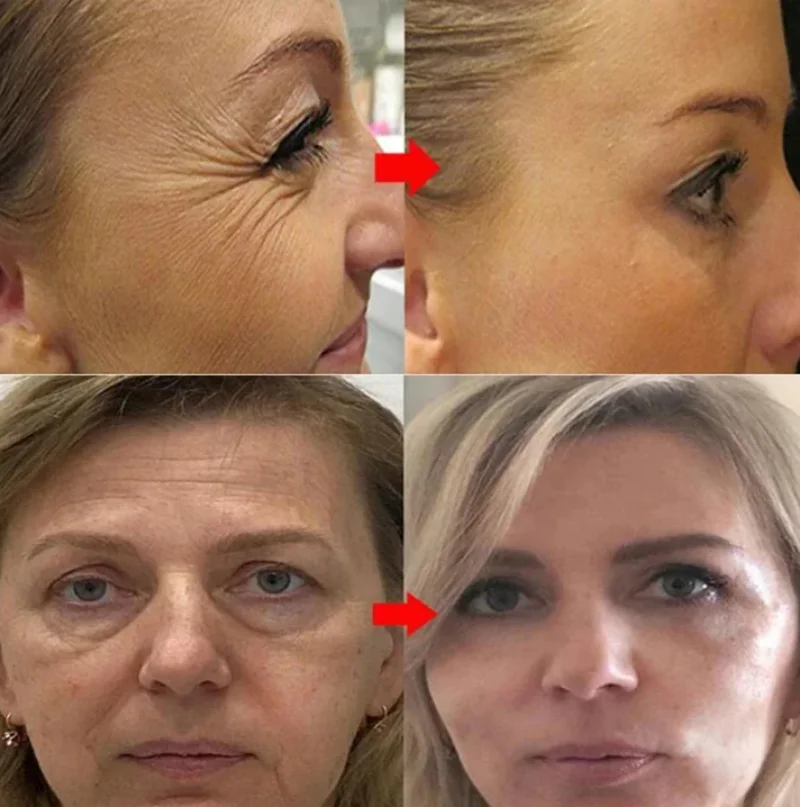 Usuwanie granulatu tłuszczu Serum pod oczy Anti Dark Circle Eye Bags Fade Fine Line Essence Anti-Puffiness Nawilżające produkty do pielęgnacji skóry