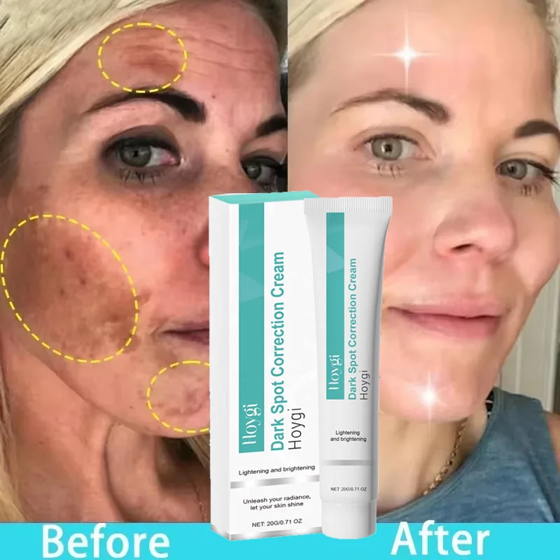 

Powerful Spot-removing Whitening Freckles Cream Remove Melasma Dark Spots Fade Pigmentation Acne Moisturizing Brighten Skin Care