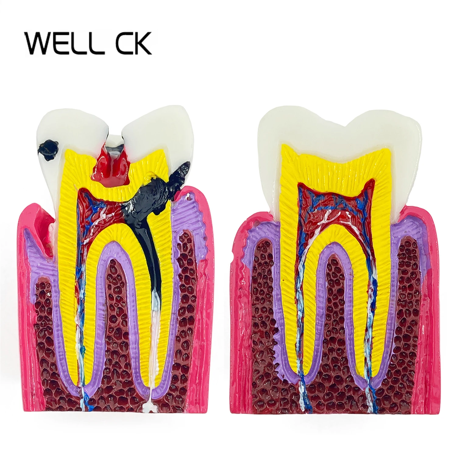 

Well CK Dental Materials Lab Teeth Model 6 Times Caries Comparation Study Models For Dentist Studying and Researching