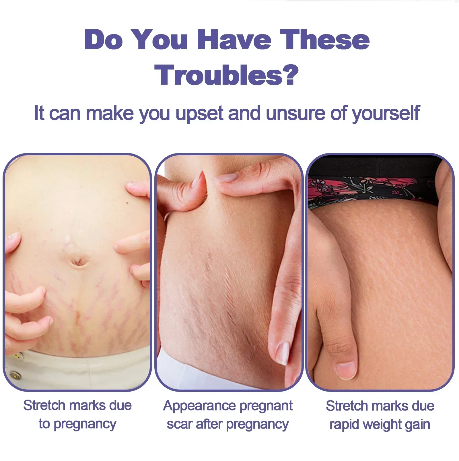 Stretch Mark Removal Cream For Pregnant Women Postpartum Repair Of Thigh Fat Lines Growth Mark Removal Cream