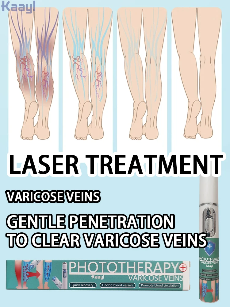 

Blue Light Laser | Varicose vein laser pointer | Laser vein