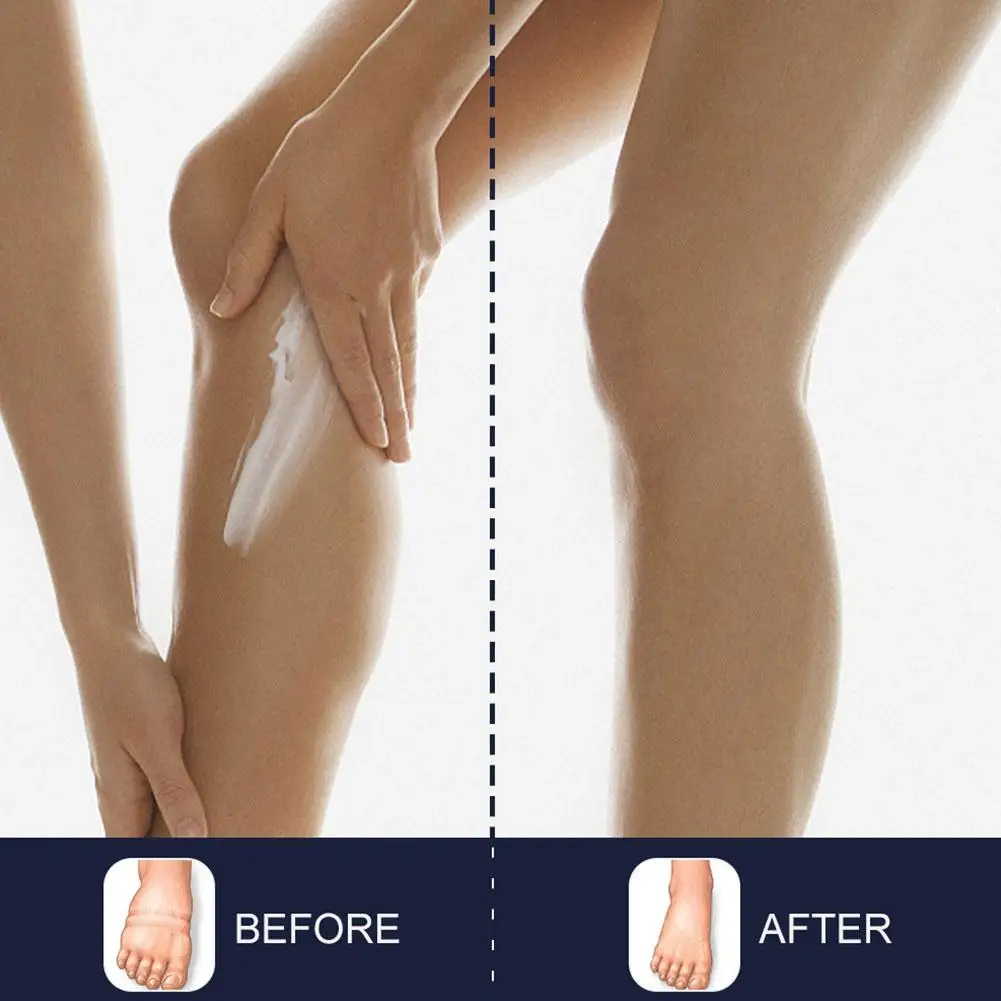 Crema per i piedi anti edema Massaggio ai piedi Crema sanitaria Alleviare efficacemente le vene varicose Braccio Gamba Gonfiore Dolore Crema rilassante