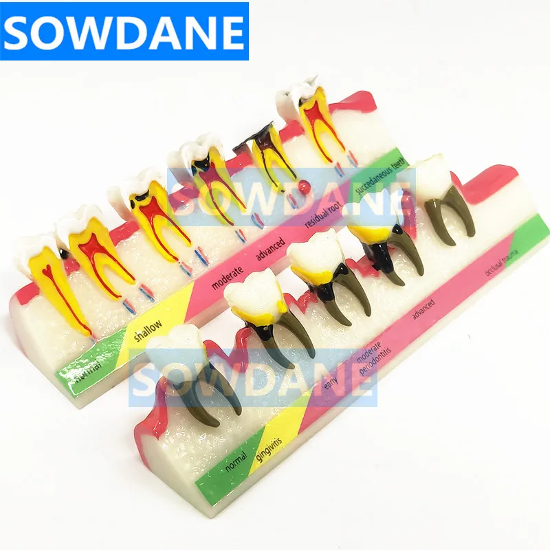 Dental Teeth Model Periodontal Disease Assort Tooth Classification Model Typodont Dental Teaching Display Model