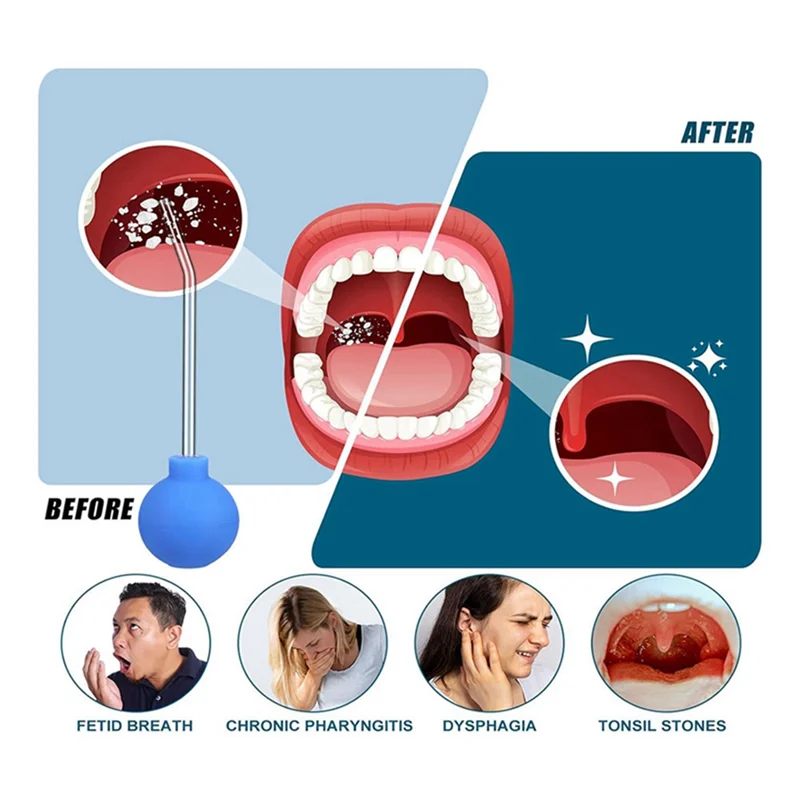 

A27U New 3Pcs Tonsil Stone Remover Kit Vacuum Cleaning Tonsil Stone Remover Set Oral Tonsil Stone Removal Tool Mouth Manual Clea
