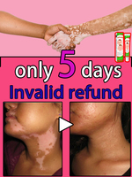 vitiligo magic tool