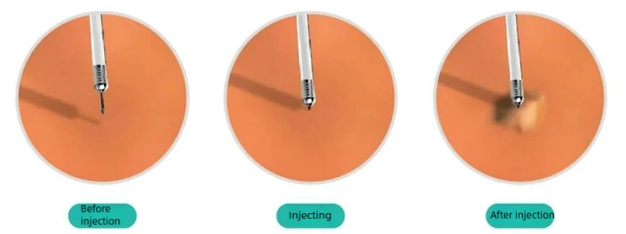 aksesoris endoskopi, JARUM INJEKSI ENDOSKOPIK SEKALI PAKAI