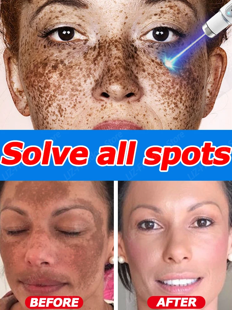 

Facia Dark Spots Dsappeared