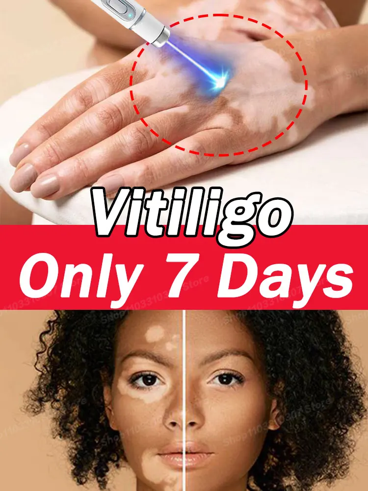 

Blu-ray Pen Vitiligo Improves White Spots
