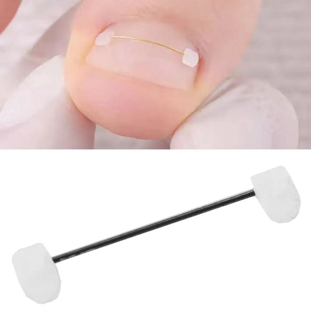 

Orthodontic Braces with Steel Wire Buckles, Biomimetic Bone Memory, And Metal Inlay for Correcting Nail Inflammation