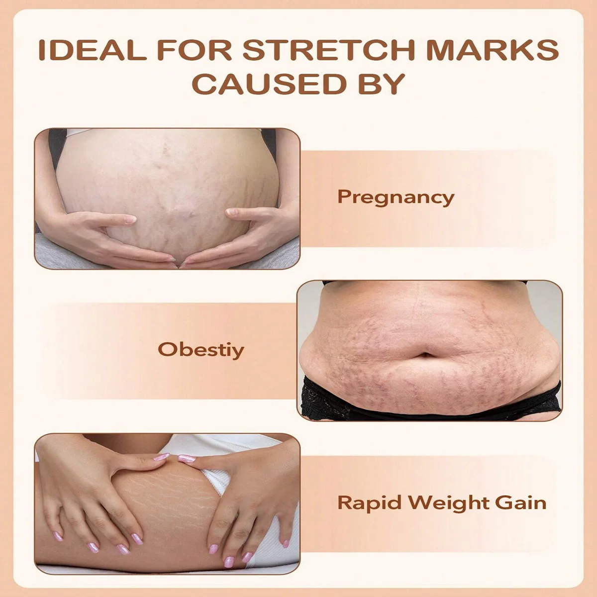 TRSTAY فيتامين E جوهر العناية بالبشرة مرطب التجاعيد الحد من الندبات والبقع يتلاشى للعناية بالحمل Striae Gravidarum #2