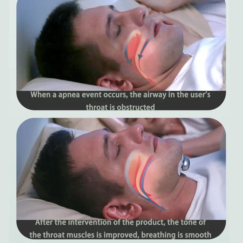 Nuevo YA4300 antironquidos inteligente, intervención de Apnea inteligente, pulso de frecuencia media y baja, antironquidos para el hogar