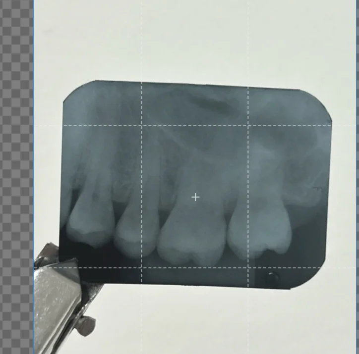 

GreatLife Dent Light Cured Hybrid Composite Flow Fluid Resin Refill Z350XT Z250XT P60 A1 A2 A3 A3.5 Dental Restoration 4g/bag