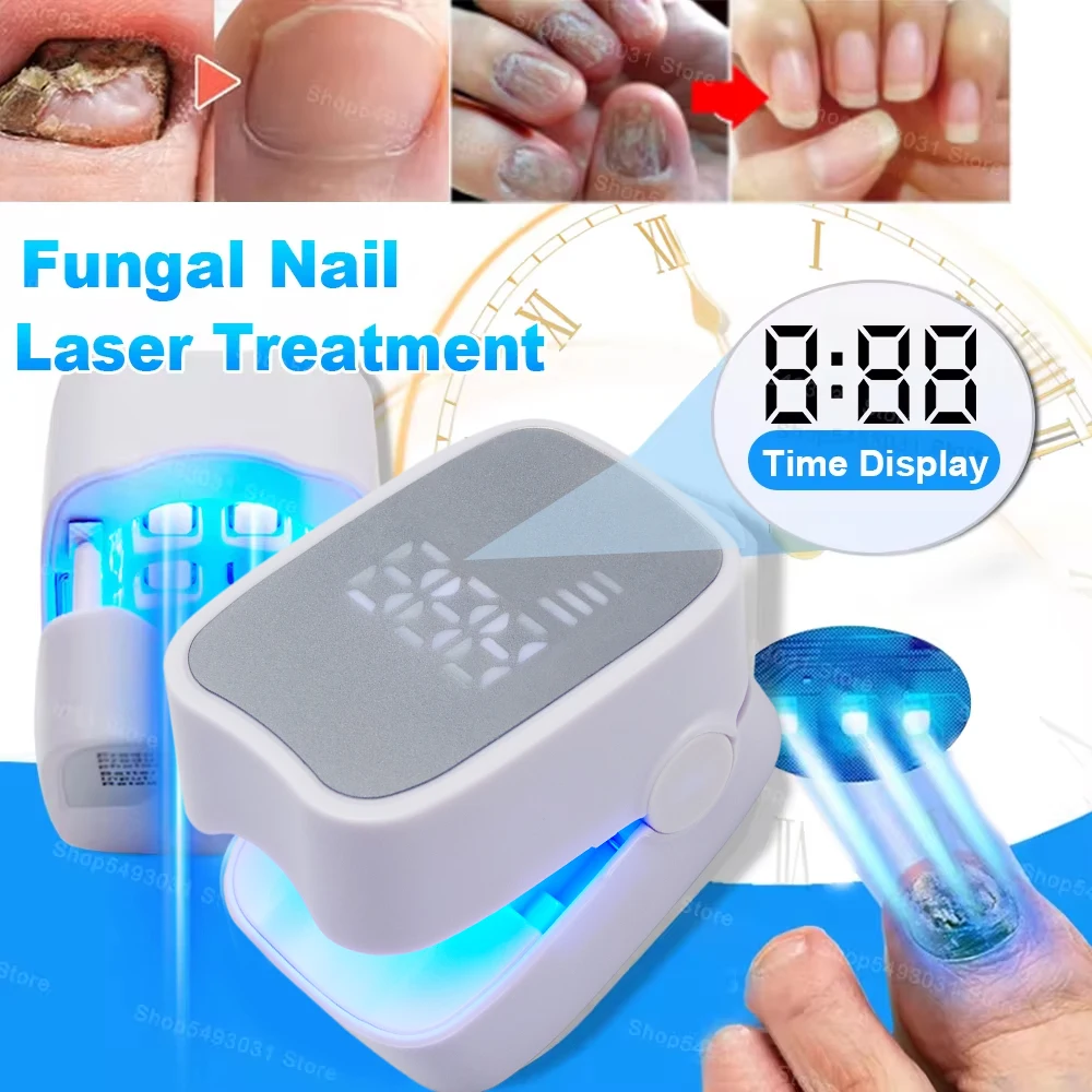 Nail Fungus Laser Treatment Effectively Remove Toenail Repair Laser for Nail Fungal Decvice Onychomycosis Therapy Treat