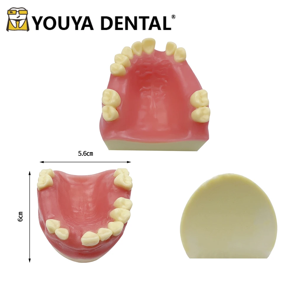 Implant Teaching Model Of Maxillary Missing Teeth for Dental Technician Training Studying Doctor-patient Communication Tool