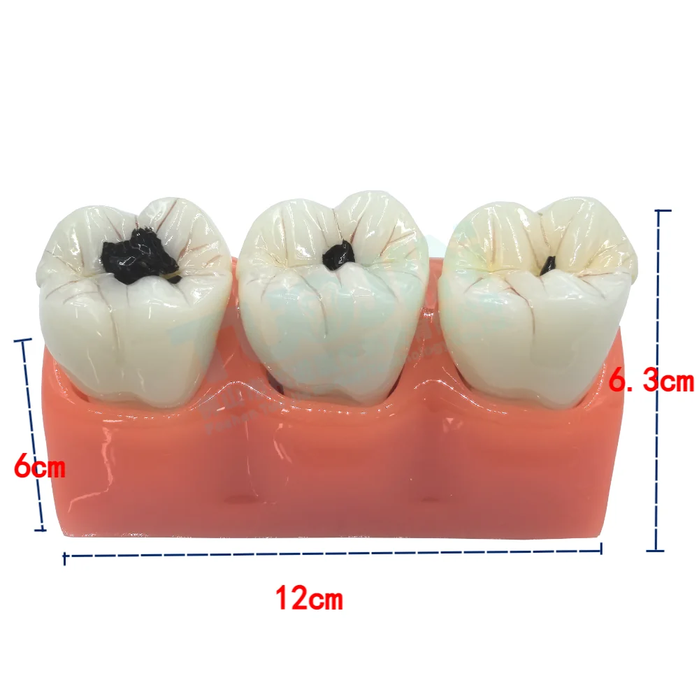 Model edukacji dentystycznej 4-krotny Model ewolucji próchnicy porównanie modelu demonstracyjnego badania dentysty narzędzia dydaktyczne