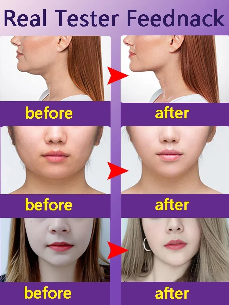 Double chin removal V lift