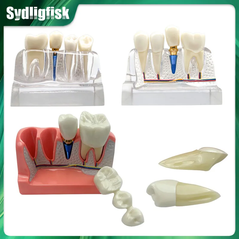 

Модель зубов для анализа дентальных имплантатов, демонстрации коронок и мостовидных протезов, съемная модель, модель зубов из фарфора для обучения и изучения стоматологов