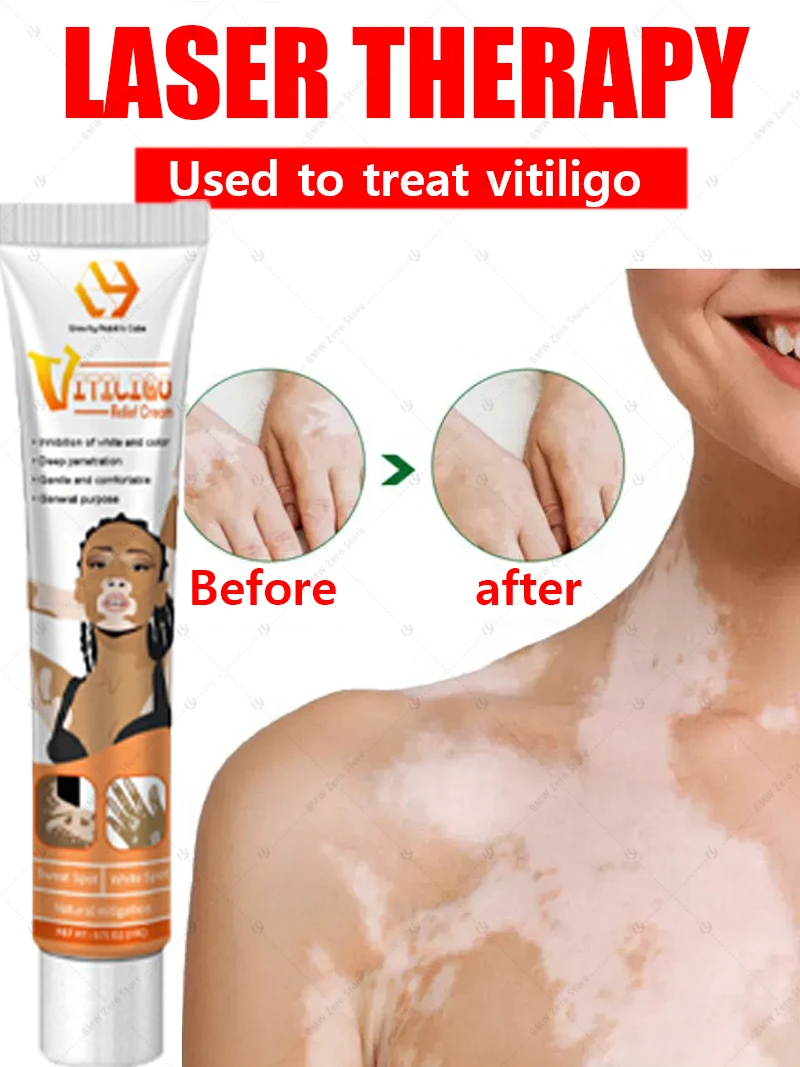 

Quickly improve vitiligo laser