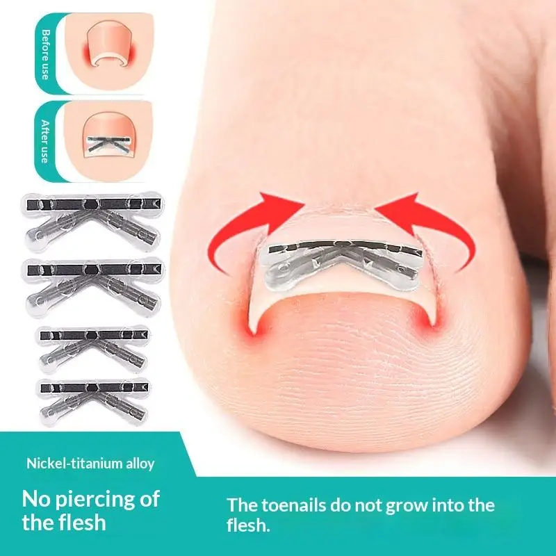 2Pcs Ingrown Toenai…