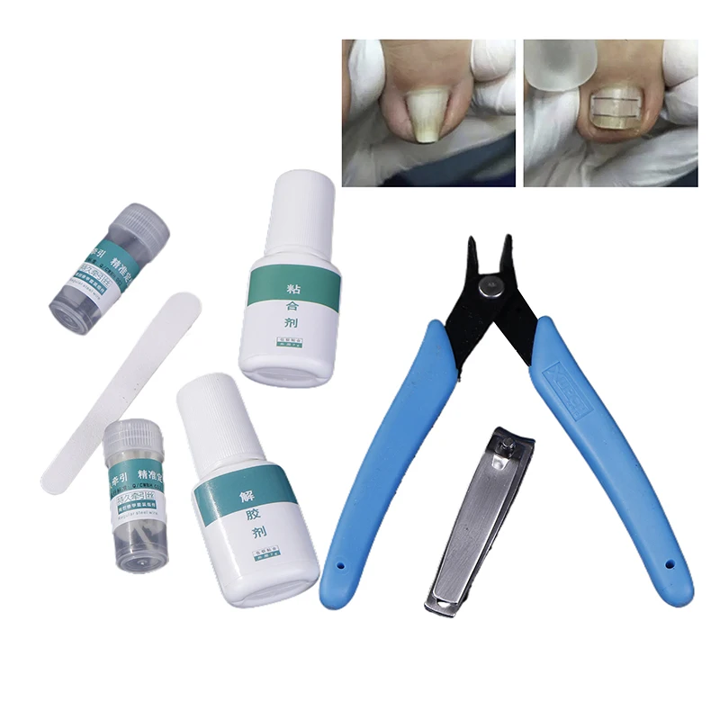 คุด Toenail Corrector เครื่องมือ Pedicure Recover ฝัง Toenail Treatment Professional คุด Toenail Correction Foot Care TOOL