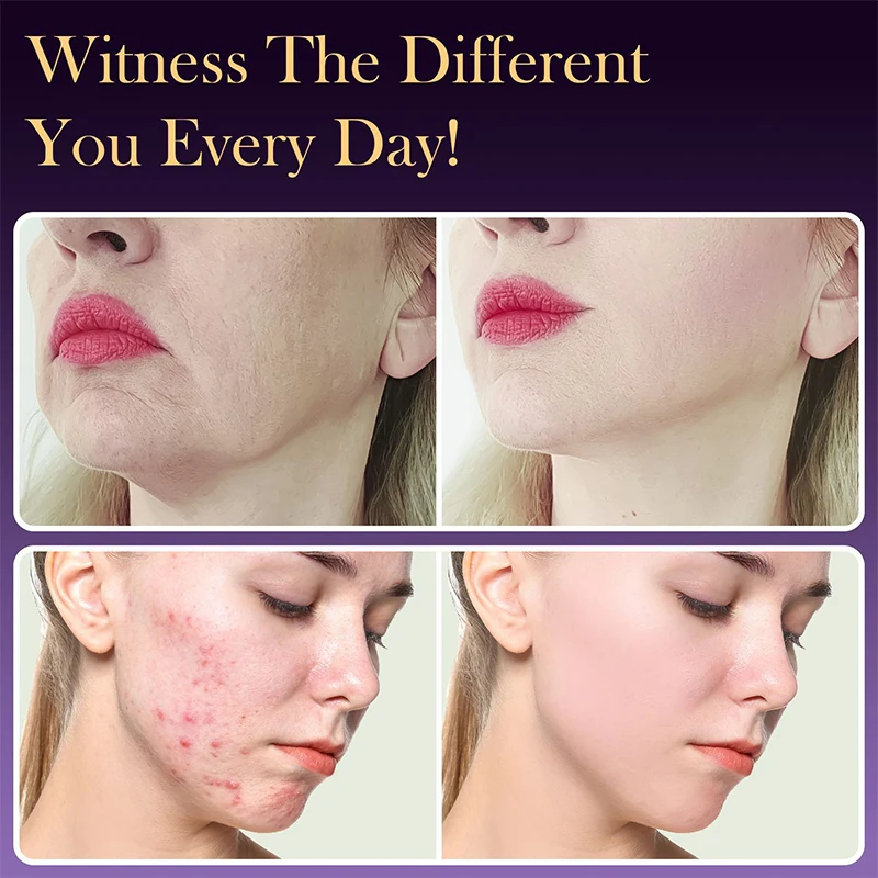 CT-005 高周波美顔機毛顔電気療法杖アルゴン治療にきびスキンケア