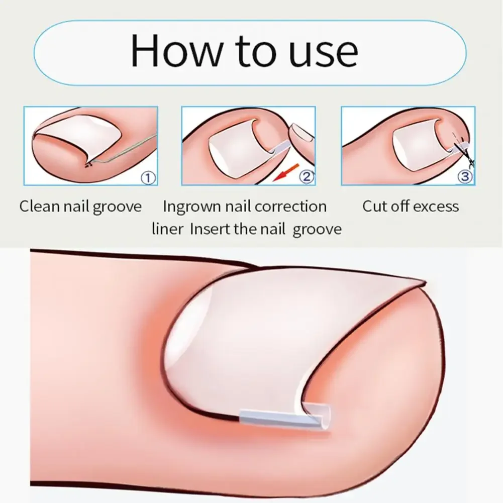 1-100PCS Ingrown Toenail Correction Ultra-thin Nail Treatment Elastic Patch Sticker Straightening Nails Groove Ingrown Corrector 1-100PCS