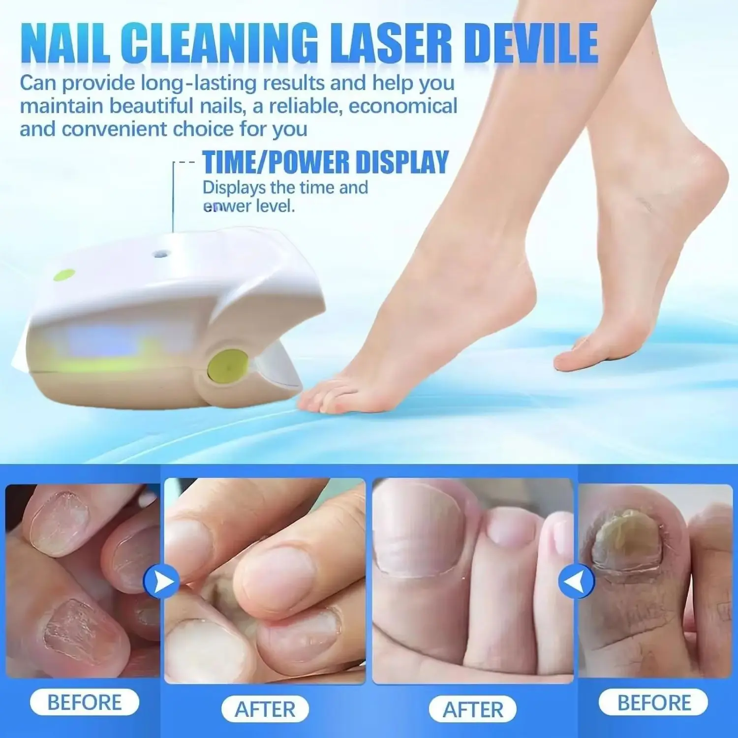 

HLKGO лазерное устройство для грибка ногтей, лазер для лечения грибка ногтей, ремонт ногтей на ногах, лечение онихомикоза, 470 нм, 905 нм