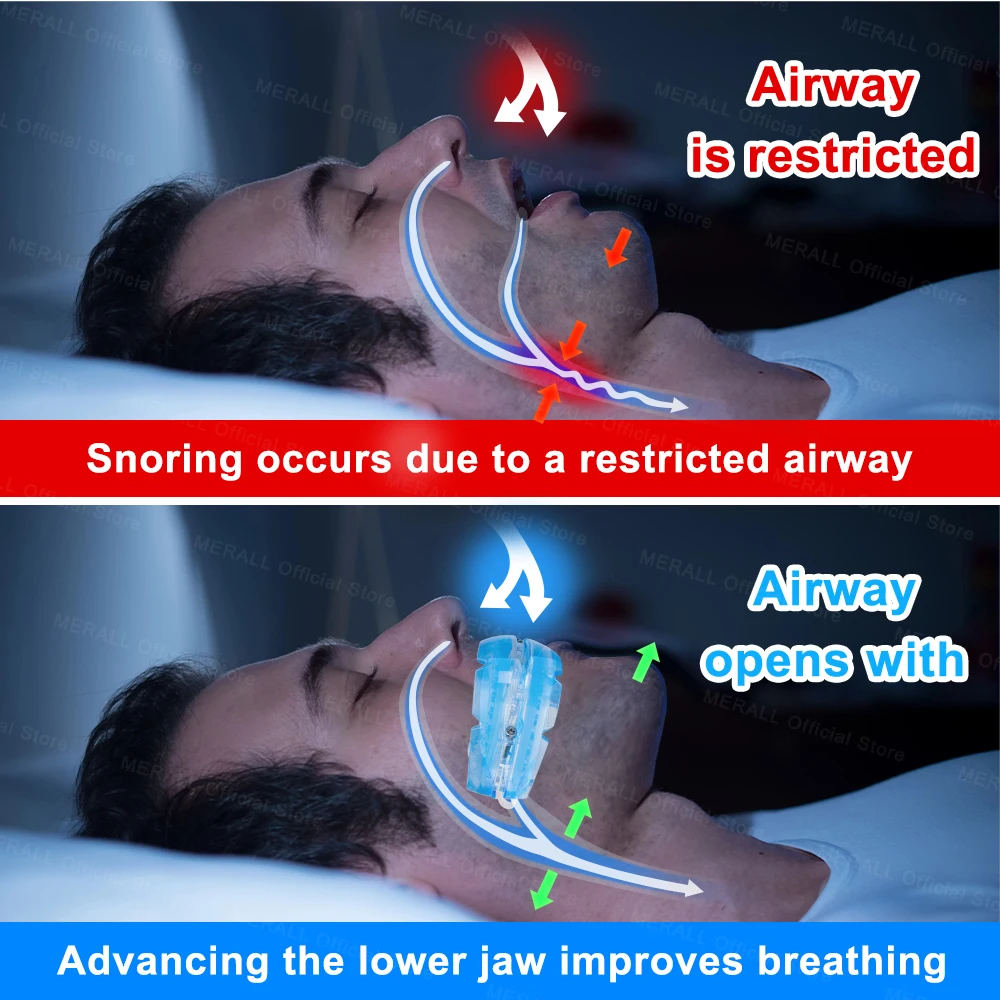 Adjustable Anti Snoring Mouthpiece Device Night Teeth Mouthguard Sleeping Aid Guard Bruxism Stop Snoring Device Improve Sleep