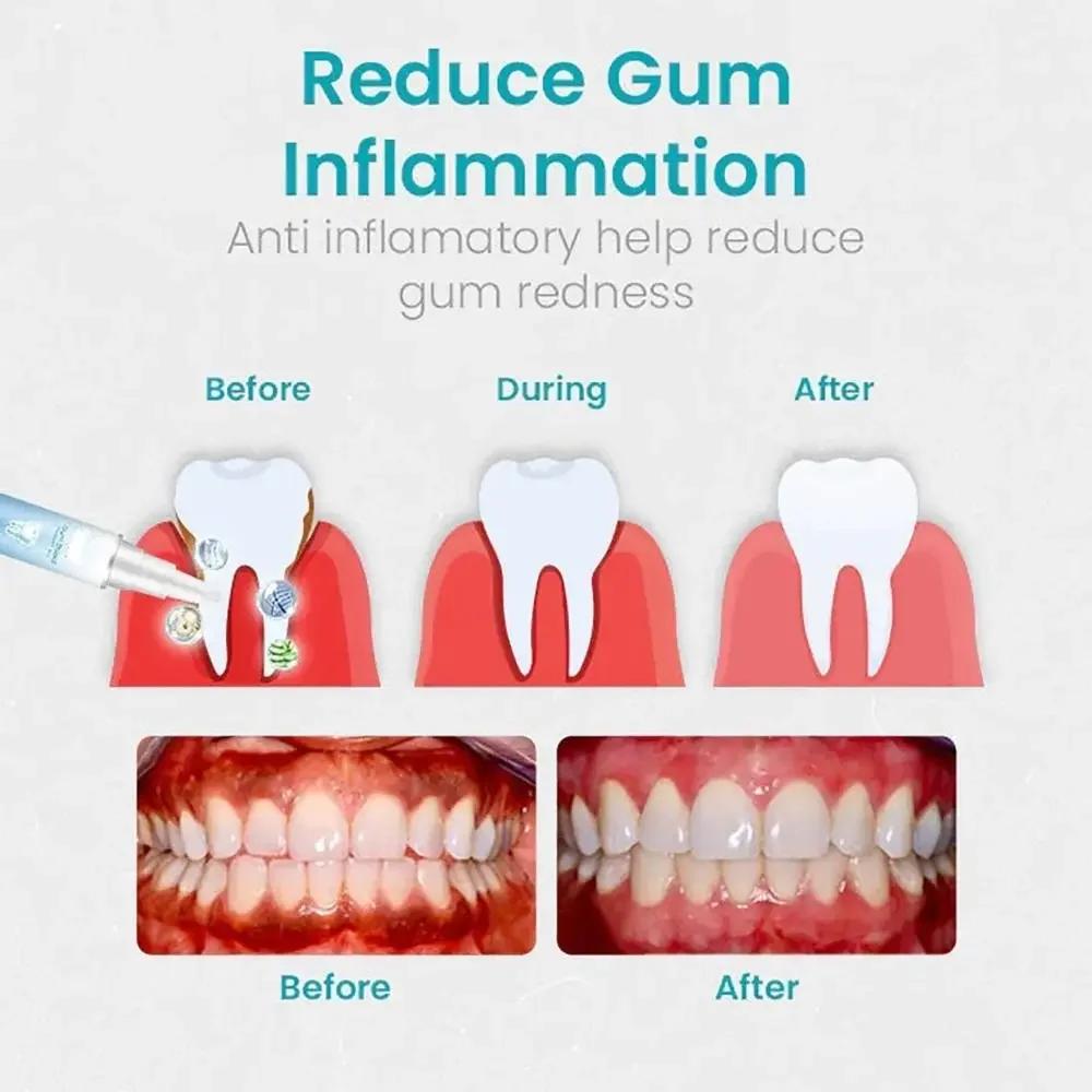 Sdatter Gum Treatment Gel Reduces Discomfort Dental Repair Gum Shield Therapy Gel Easy to Use Reduces Inflammation Oral Care