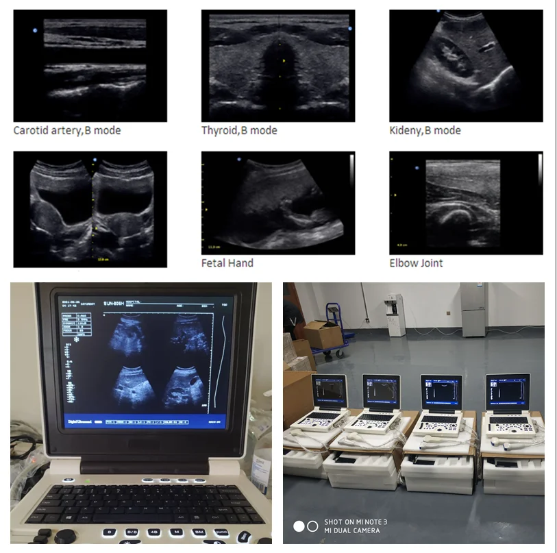 SUN-806H Diagnostic Ultrasound System 2D ultrasound Imaging Ultrasonic Machine