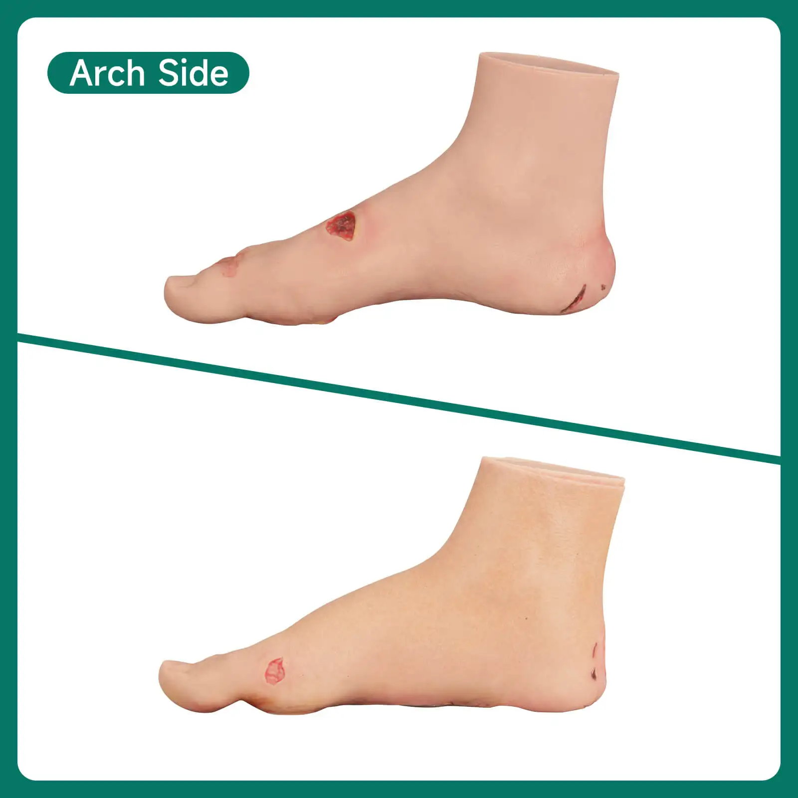 Ultrassist Diabetic Foot Ulcer Model Set Mild & Severe Stages Anatomical Accuracy Pathology Study Tool for Medical Training