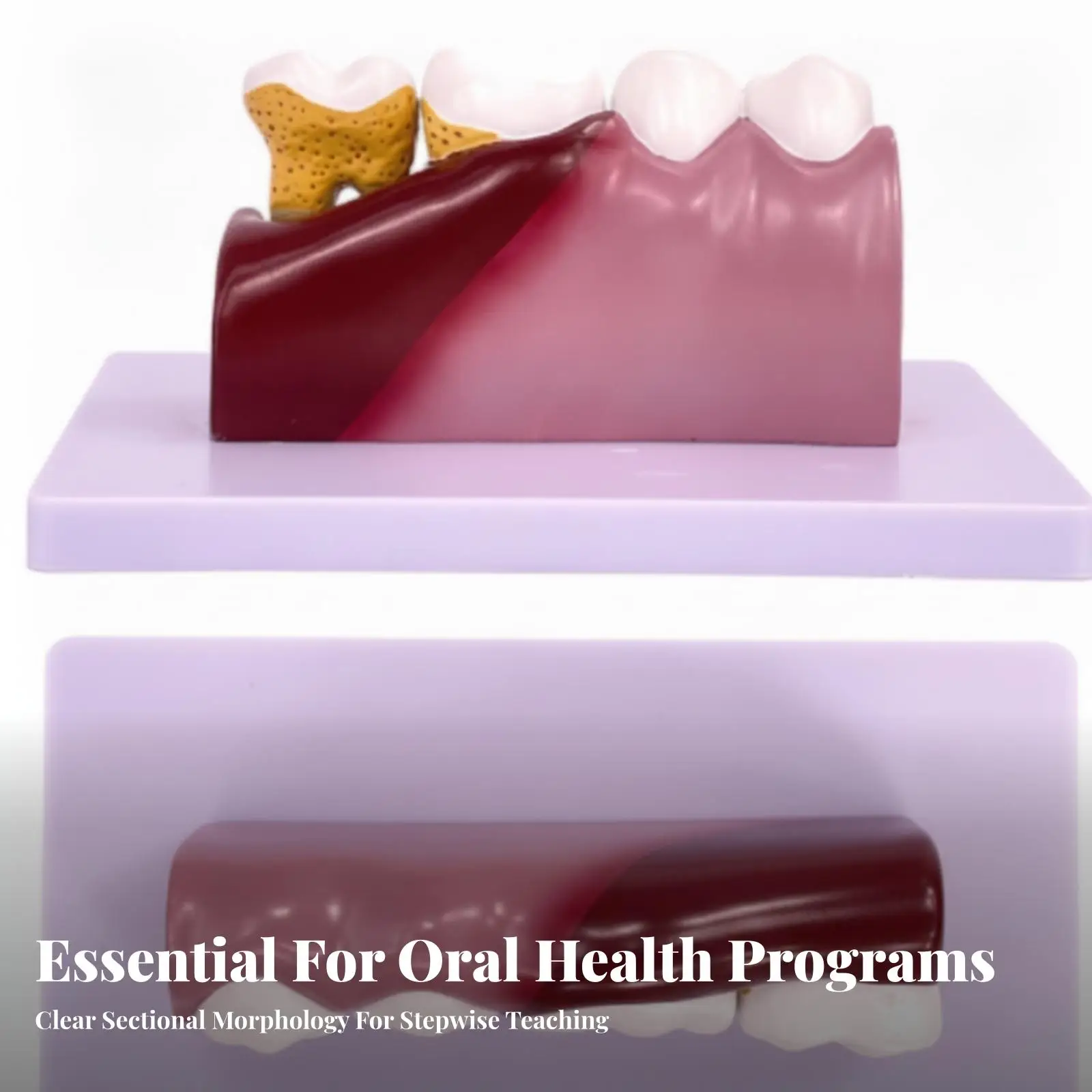 Oral Pathology Teaching Model Tooth Anatomy Cross Section Caries Root Canal Pulp for Student Study