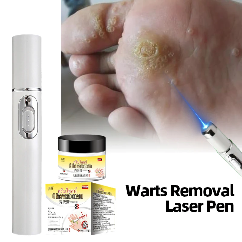 

Wart Remover Laser Pen for Men and Women Advanced Treatment for Plantar Genital Common Corn Warts