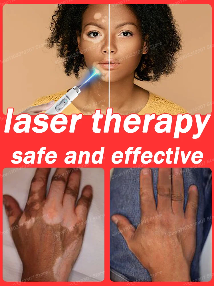 

Laser therapy Vitiligo