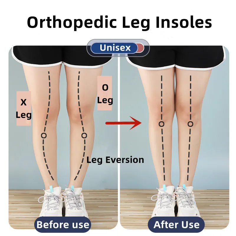 Palmilhas ortopédicas de silicone para pés o/x tipo perna valgus varus correção fasciite plantar gel palmilha ímã massagem cuidados com os pés