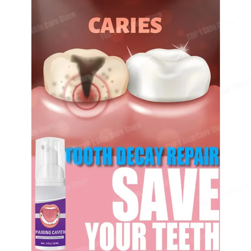 Tooth Decay Repair All Cavities, Protect Teeth Remove Plaque Stains Tooth Decay Repair Teeth Whitening Dental