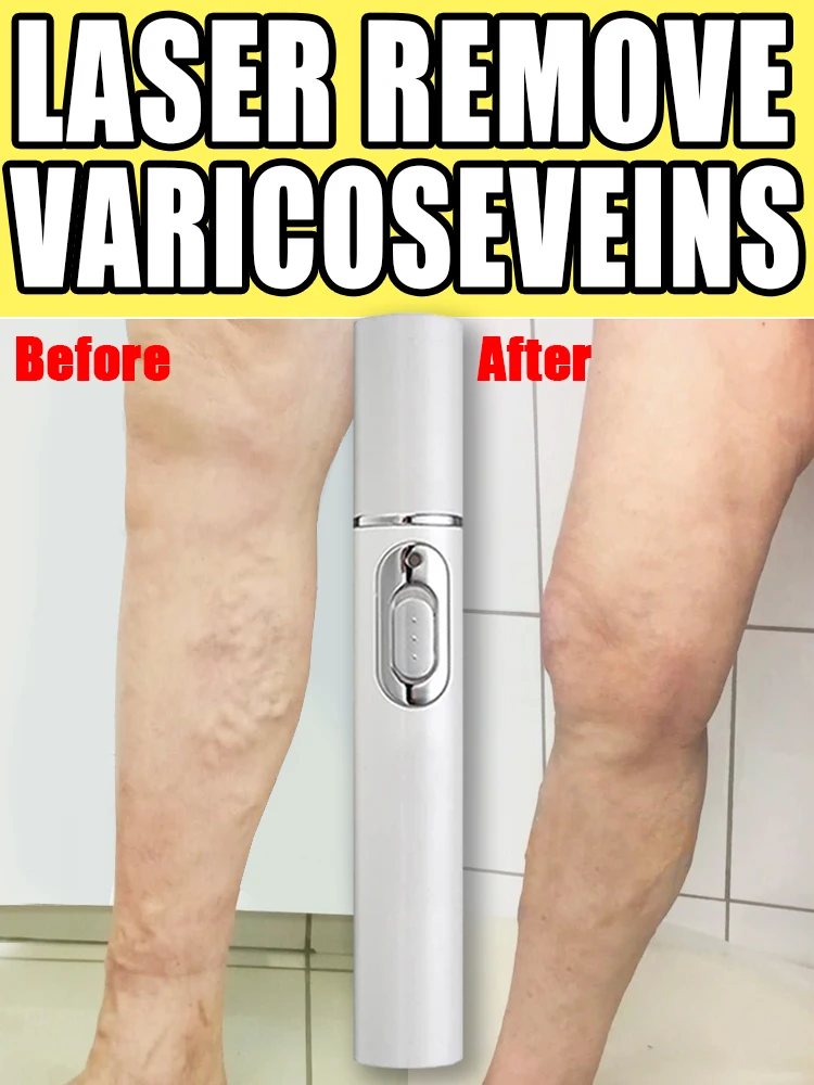 

Varicose Vein Instrument Early Use Early Improvement