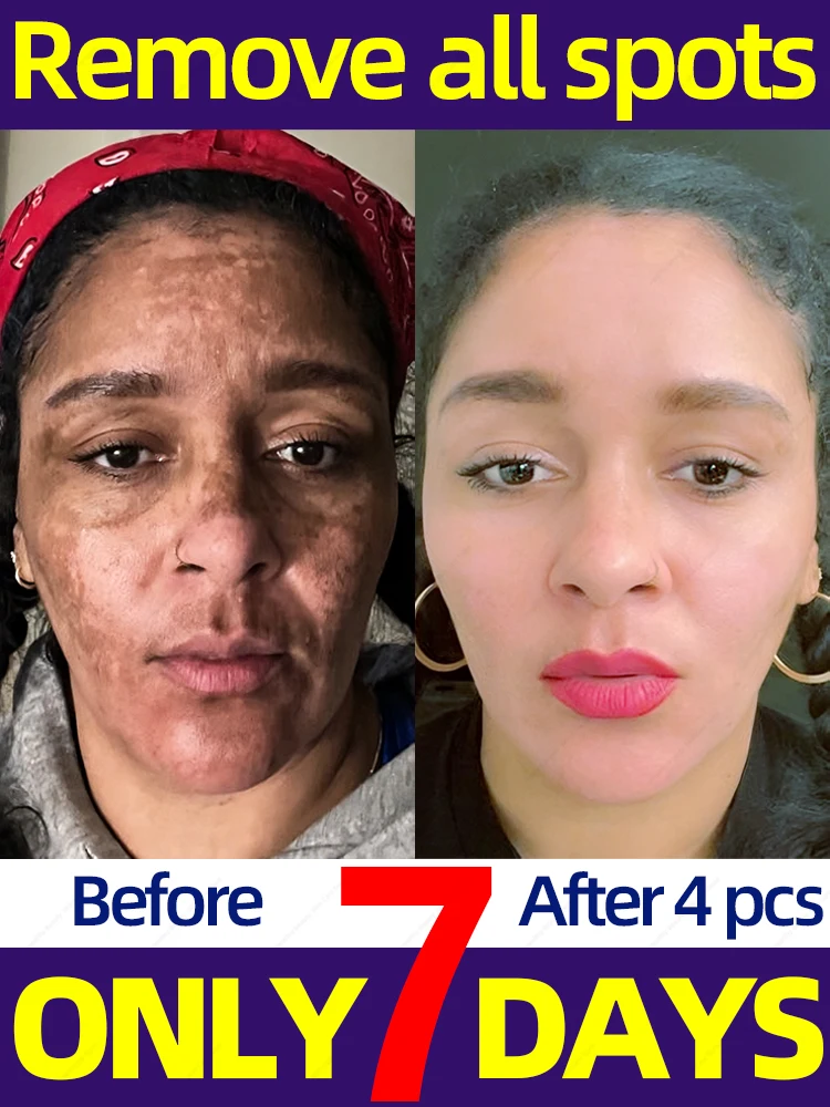 

freckles removal cream remove dark spots melasma