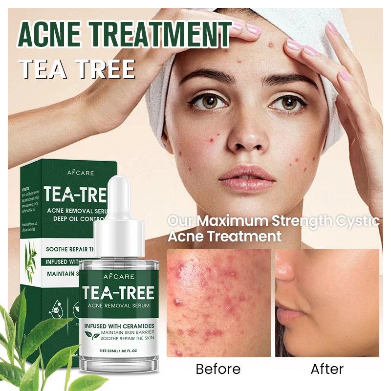 

Лечение прыщей, крем с чайным деревом, крем для лица против прыщей, удаление пятен, контроль жирности, сужение пор, увлажняющий крем для ухода за кожей