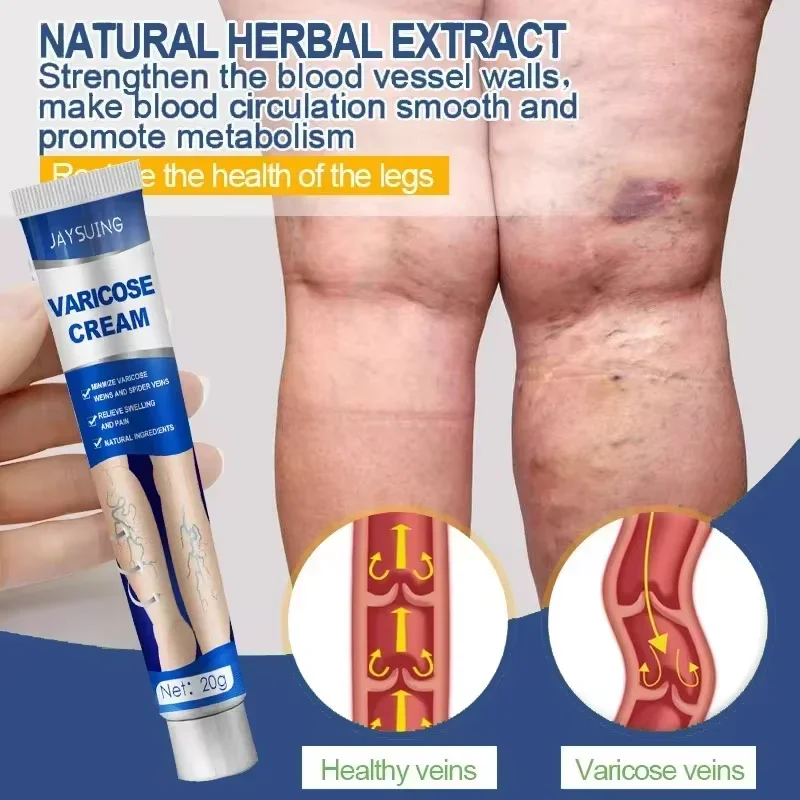 Pomada para venas varicosas, crema efectiva para aliviar la Vasculitis, flebitis, tratamiento del dolor de araña, cuidado de los pies